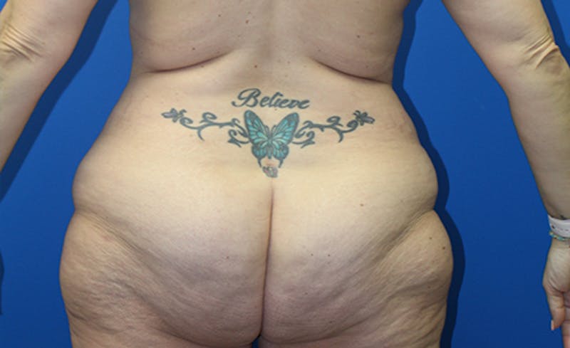 Abdominoplasty Before & After Gallery - Patient 378649 - Image 7