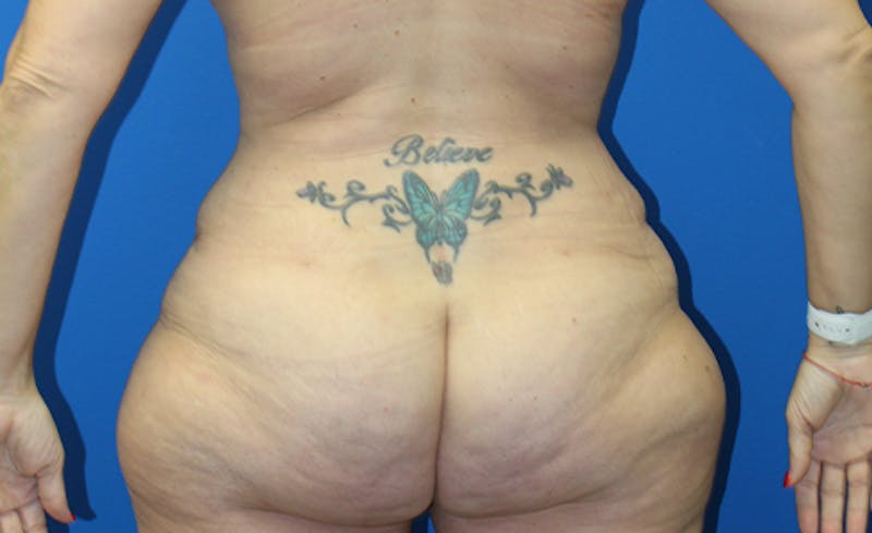 Abdominoplasty Before & After Gallery - Patient 378649 - Image 8
