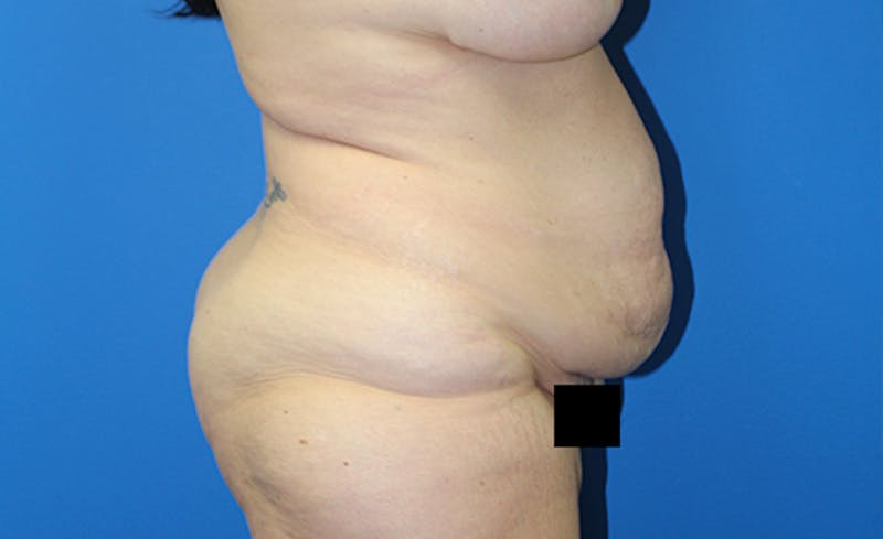 Abdominoplasty Before & After Gallery - Patient 378649 - Image 9