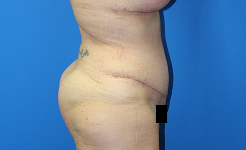 Abdominoplasty Before & After Gallery - Patient 378649 - Image 10