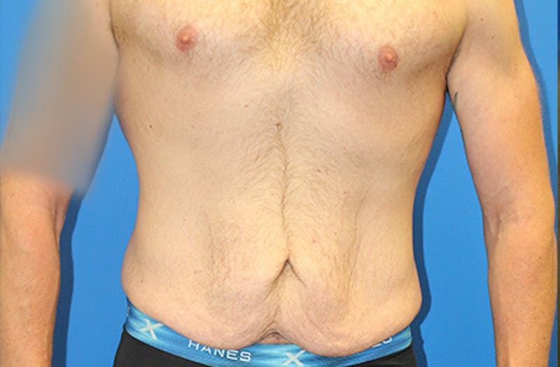 Abdominoplasty Before & After Gallery - Patient 214339 - Image 1