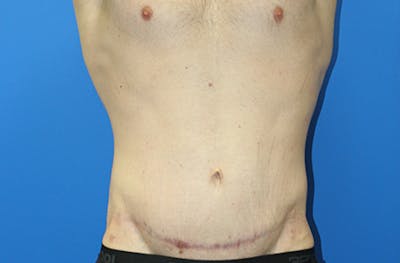 Body Lift Before & After Gallery - Patient 350300 - Image 2
