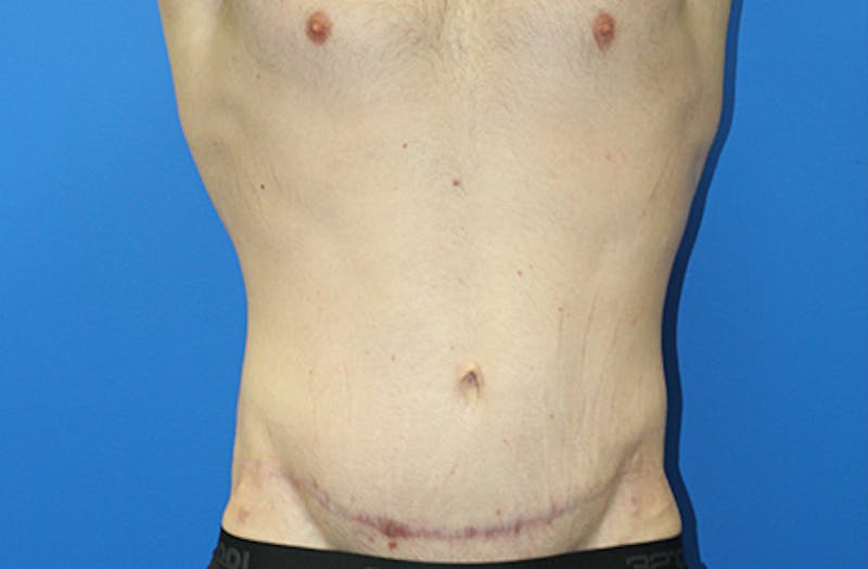 Abdominoplasty Before & After Gallery - Patient 214339 - Image 2