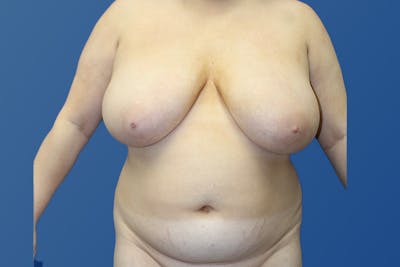 Liposuction Before & After Gallery - Patient 313675 - Image 1