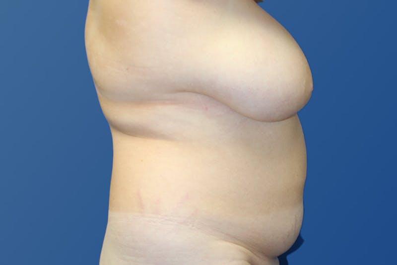 Liposuction Before & After Gallery - Patient 313675 - Image 3