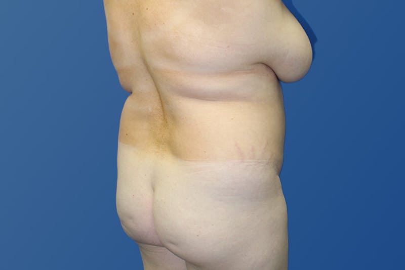 Liposuction Before & After Gallery - Patient 313675 - Image 5