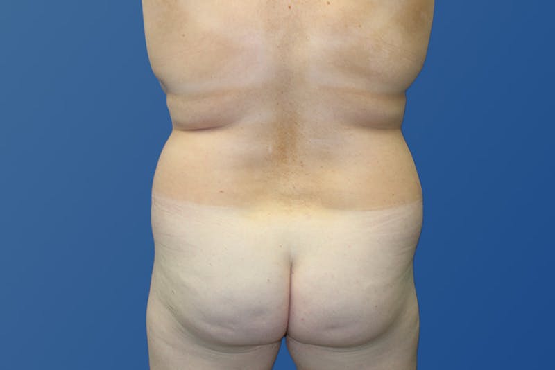 Liposuction Before & After Gallery - Patient 313675 - Image 7