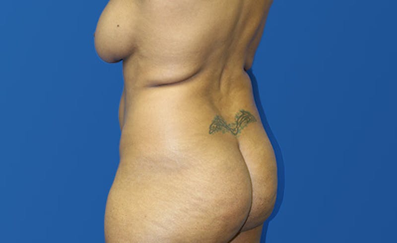Liposuction Before & After Gallery - Patient 444014 - Image 3
