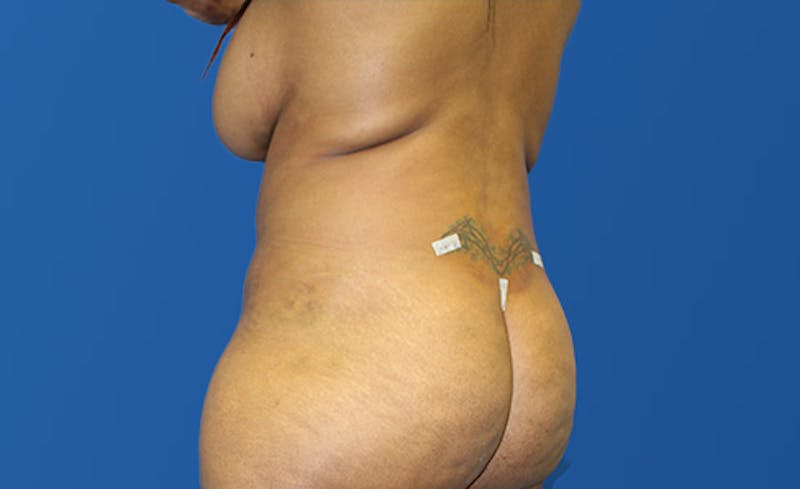 Liposuction Before & After Gallery - Patient 444014 - Image 4