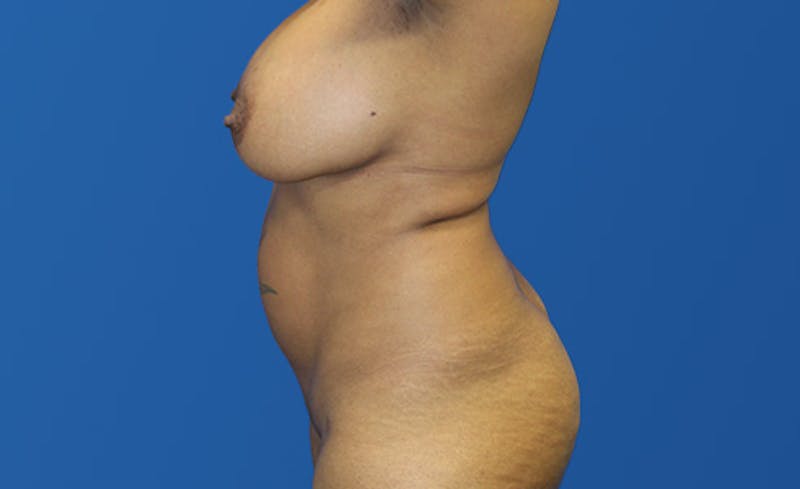 Liposuction Before & After Gallery - Patient 444014 - Image 5