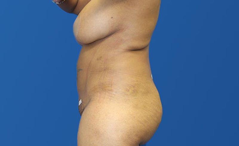 Liposuction Before & After Gallery - Patient 444014 - Image 6