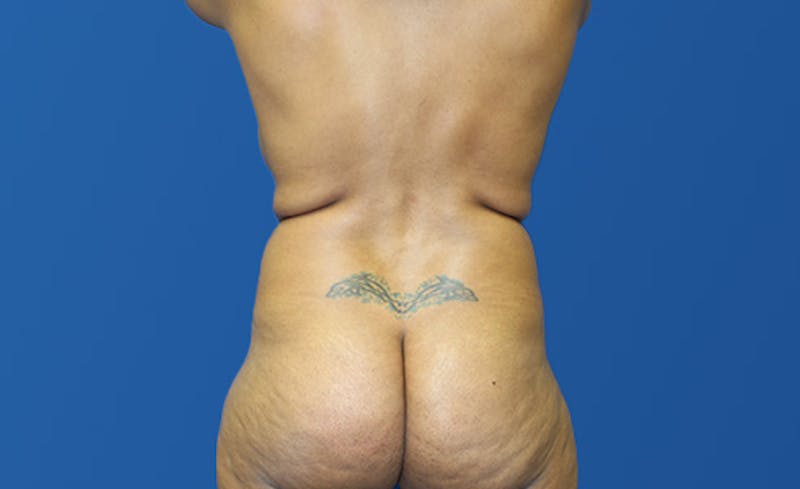 Liposuction Before & After Gallery - Patient 444014 - Image 7