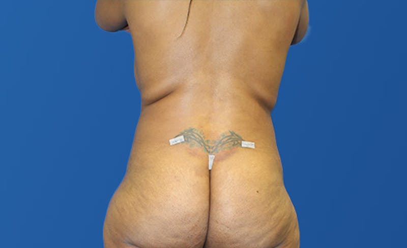 Liposuction Before & After Gallery - Patient 444014 - Image 8