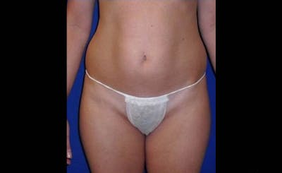 Liposuction Before & After Gallery - Patient 413582 - Image 1