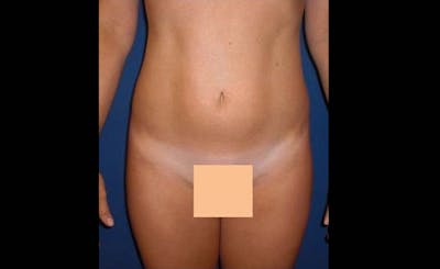 Liposuction Before & After Gallery - Patient 413582 - Image 2
