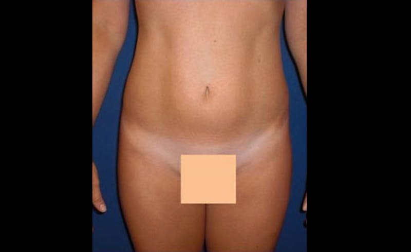 Liposuction Before & After Gallery - Patient 413582 - Image 2