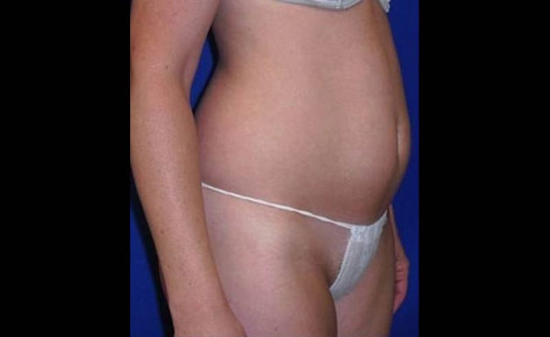 Liposuction Before & After Gallery - Patient 413582 - Image 3