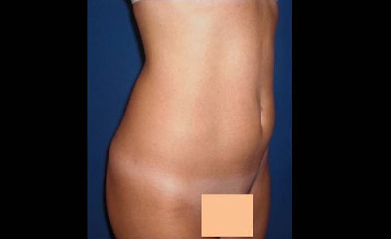 Liposuction Before & After Gallery - Patient 413582 - Image 4
