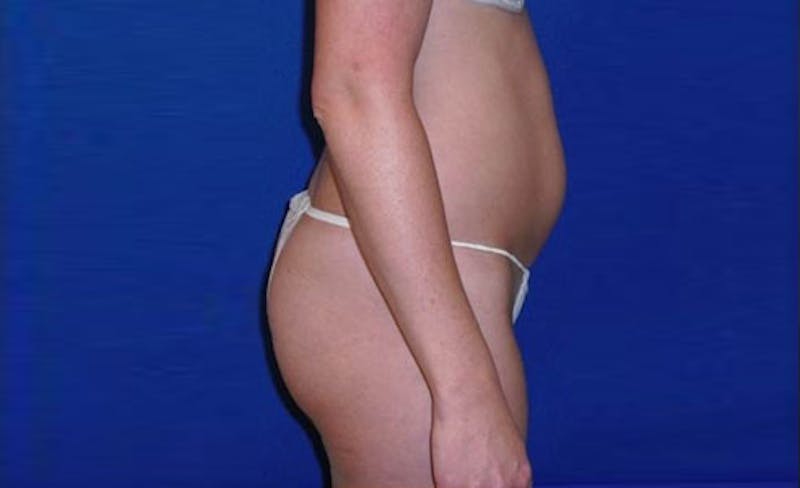 Liposuction Before & After Gallery - Patient 413582 - Image 5