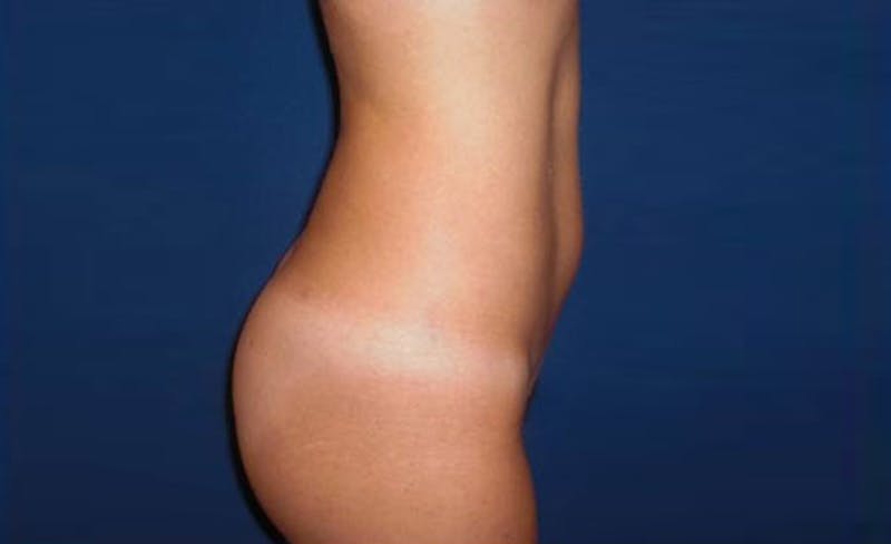 Liposuction Before & After Gallery - Patient 413582 - Image 6