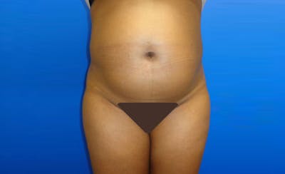 Liposuction Before & After Gallery - Patient 164823 - Image 1