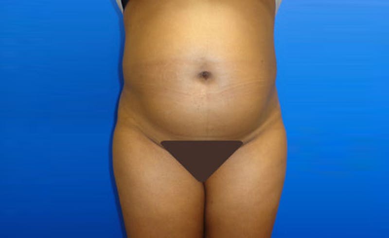 Liposuction Before & After Gallery - Patient 164823 - Image 1