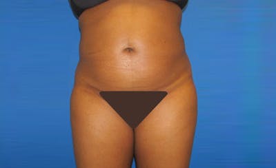 Liposuction Before & After Gallery - Patient 164823 - Image 2