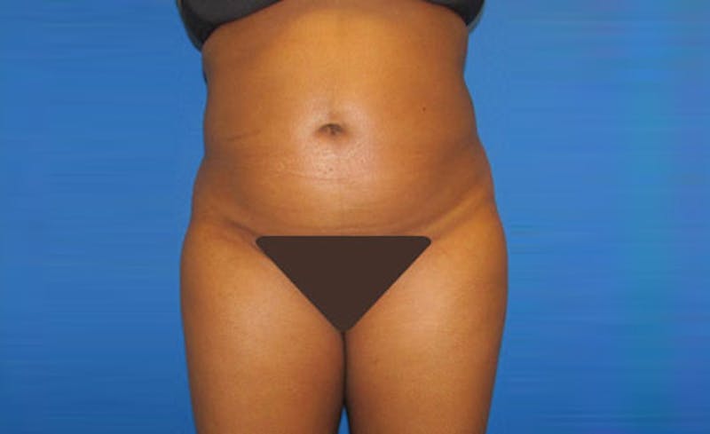 Liposuction Before & After Gallery - Patient 164823 - Image 2