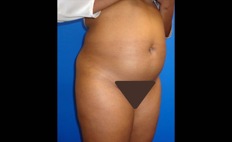 Liposuction Before & After Gallery - Patient 164823 - Image 3