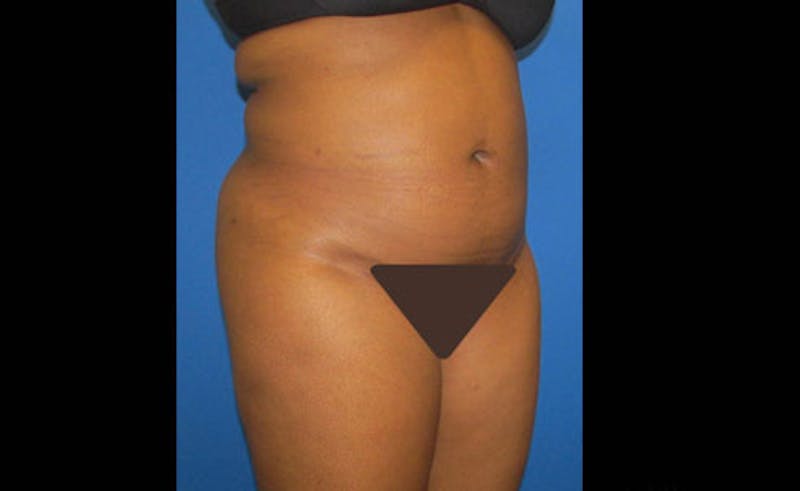 Liposuction Before & After Gallery - Patient 164823 - Image 4