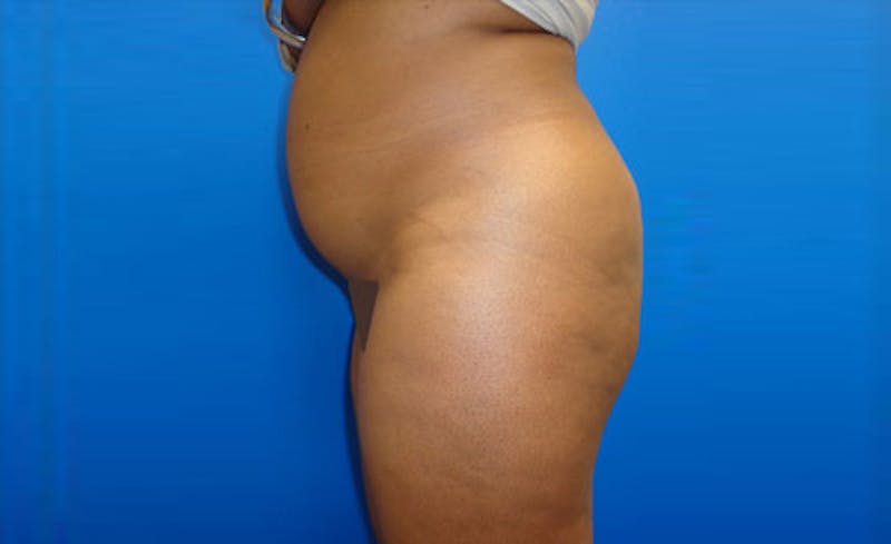 Liposuction Before & After Gallery - Patient 164823 - Image 5