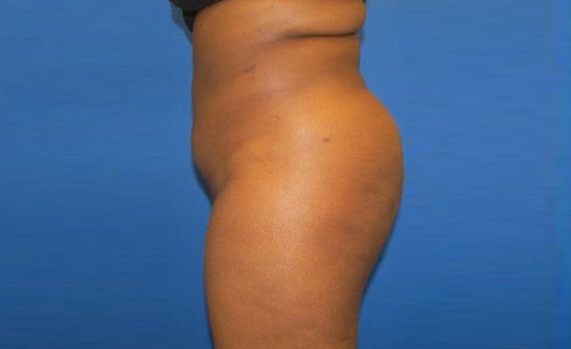 Liposuction Before & After Gallery - Patient 164823 - Image 6