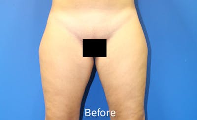 Liposuction Before & After Gallery - Patient 391578 - Image 1