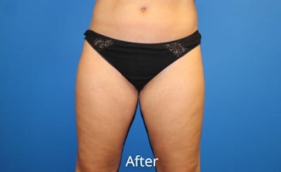 Liposuction Before & After Gallery - Patient 391578 - Image 2