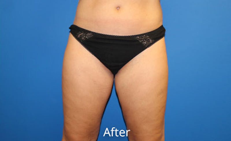 Liposuction Before & After Gallery - Patient 391578 - Image 2