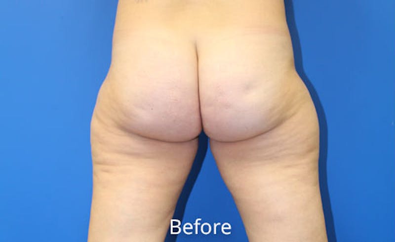 Liposuction Before & After Gallery - Patient 391578 - Image 3