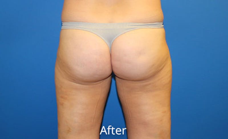 Liposuction Before & After Gallery - Patient 391578 - Image 4