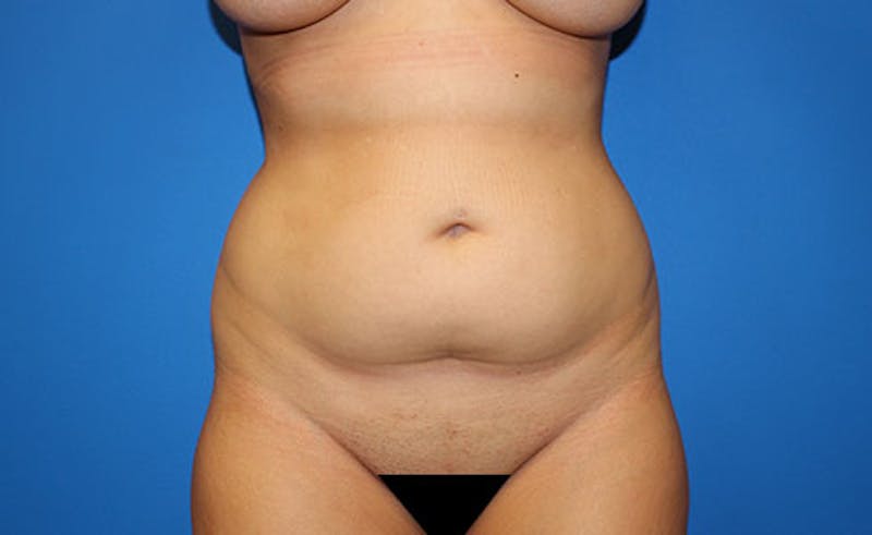 Liposuction Before & After Gallery - Patient 451131 - Image 1