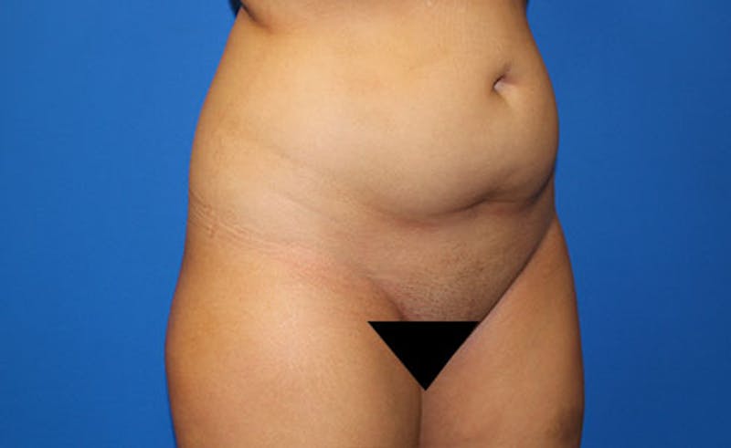 Liposuction Before & After Gallery - Patient 451131 - Image 3