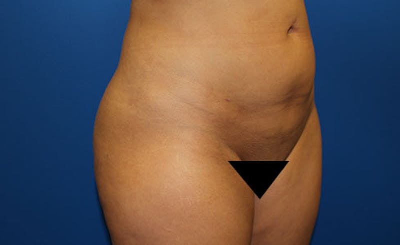 Liposuction Before & After Gallery - Patient 451131 - Image 4