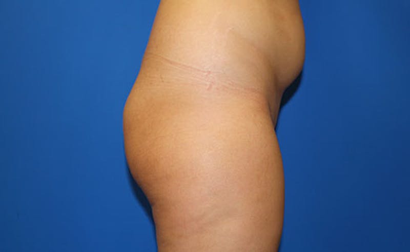 Liposuction Before & After Gallery - Patient 451131 - Image 5
