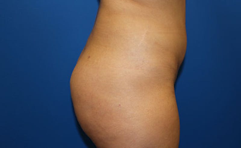 Liposuction Before & After Gallery - Patient 451131 - Image 6
