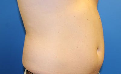 Liposuction Before & After Gallery - Patient 191654 - Image 1