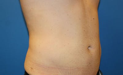 Liposuction Before & After Gallery - Patient 191654 - Image 2