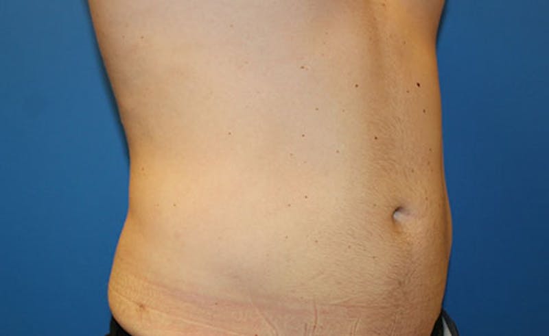 Liposuction Before & After Gallery - Patient 191654 - Image 2