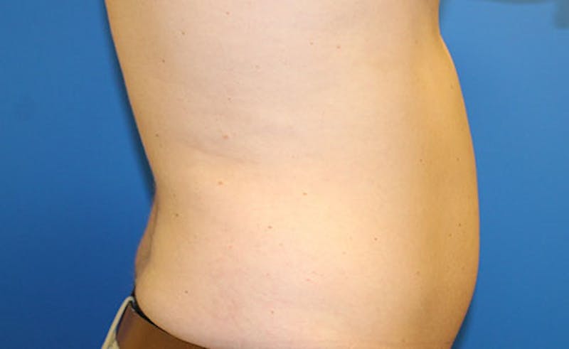 Liposuction Before & After Gallery - Patient 191654 - Image 3
