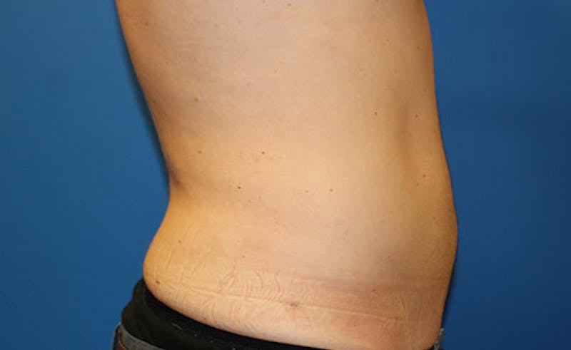Liposuction Before & After Gallery - Patient 191654 - Image 4