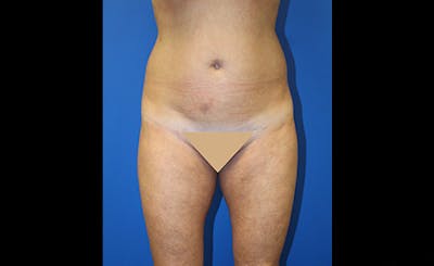 Liposuction Before & After Gallery - Patient 229267 - Image 1