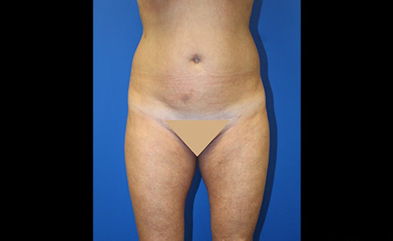 Liposuction Before & After Gallery - Patient 229267 - Image 1