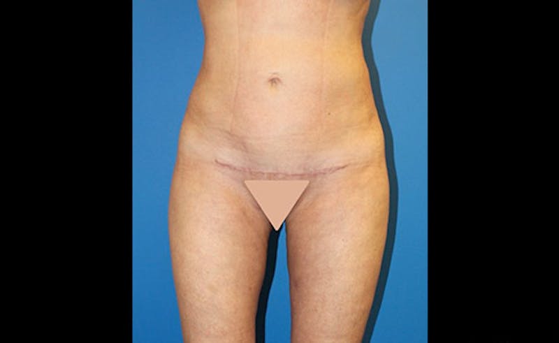 Liposuction Before & After Gallery - Patient 229267 - Image 2